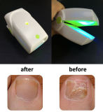 High Effective Semiconductor Laser Therapy Instrument for Nail Fungus