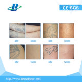 Q Switched ND YAG Laser Tattoo Removal Pigment Removal Laser