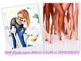 755 808 1064 Triple Wavelength Diode Laser Hair Removal